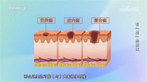 微凸的痣|身上的痣能抠吗？凸起的痣和平平的痣哪个更易恶。